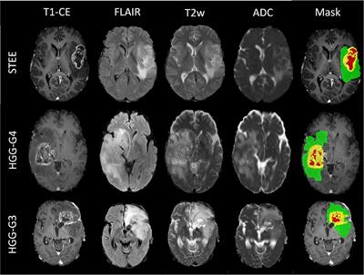 Developing a Radiomics Signature for Supratentorial Extra-Ventricular Ependymoma Using Multimodal MR Imaging